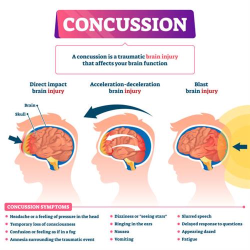 concussion